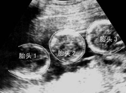 2026深圳试管婴儿花费多少？三代试管费用明细！